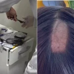 Erro na coleta de cabelo para exame toxicológico gera polêmica entre motoristas