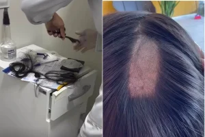 Erro na coleta de cabelo para exame toxicológico gera polêmica entre motoristas